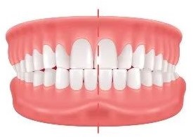 Crossbite