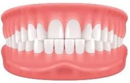 underbite